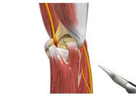 Ulnar Nerve Transposition