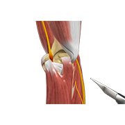 Ulnar Nerve Transposition