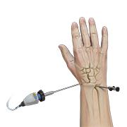 Wrist Arthroscopy