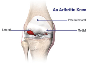 Arthritic Knee