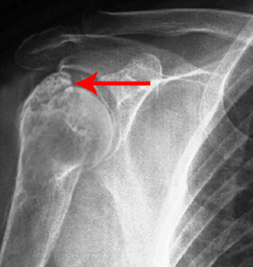 Malunion Surgery of the Shoulder