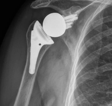 Shoulder Arthroplasty
