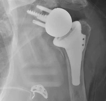 Joint Replacement Surgeries