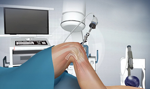 Arthroscopic ACL Reconstruction