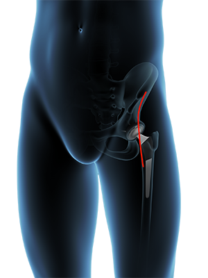 Direct Anterior Approach 