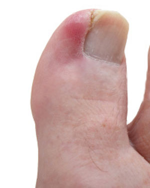 Ingrown Toenail