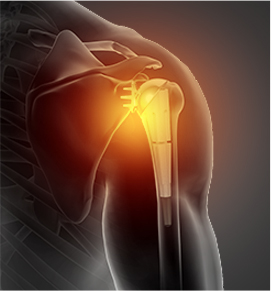 Shoulder-Arthroplasty