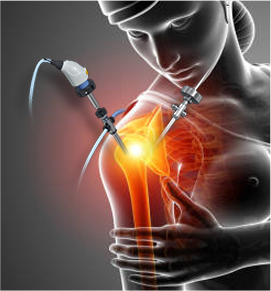 Shoulder-Arthroscopy