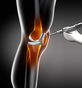 Knee-Arthroplasty
with Mako
