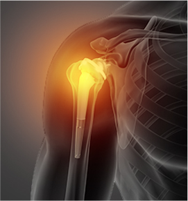 Reverse-Shoulder Arthroplasty