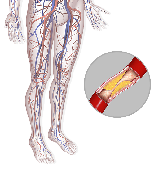 Peripheral Arterial Disease (PAD)