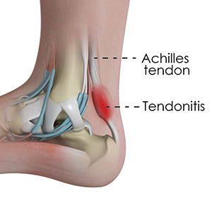 Achilles Tendinitis