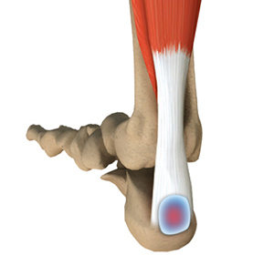 Achilles-tendon-bursitis