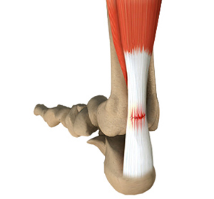 Achilles Tendon Rupture