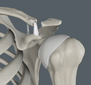 Acromioclavicular (AC) Joint