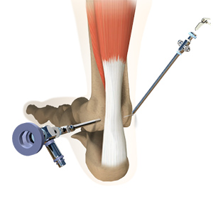 Ankle Arthroscopy
