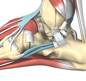 Ankle-ligament-reconstruction