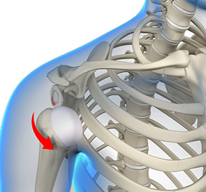 Shoulder Instability