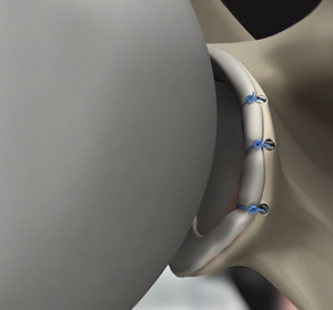 Anterior Shoulder Stabilization