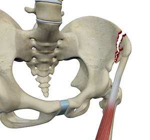 Avulsion fractures of the Pelvis