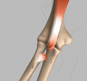 Biceps Tendon