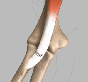 Biceps Tendon Repair