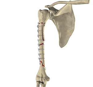 Fracture Repair of the Shoulder