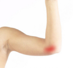 Cubital Tunnel Syndrome