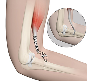 distal-biceps-repair