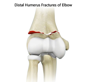 distal-humerus-fractures-of-elbow