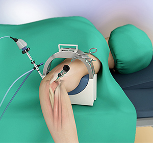 elbow-arthrocopy