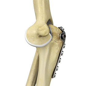 Elbow Fracture Reconstruction