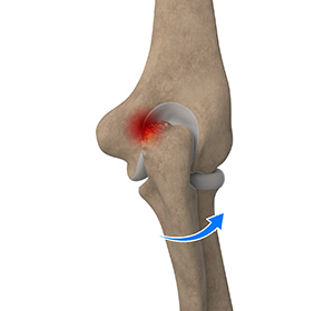 Elbow Impingement