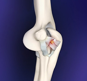 Elbow-ligament-reconstruction