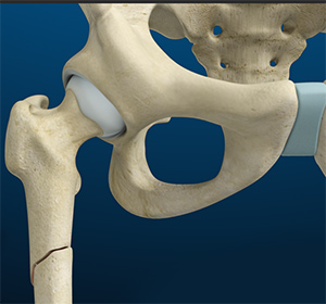  Femoral Shaft Fracture
