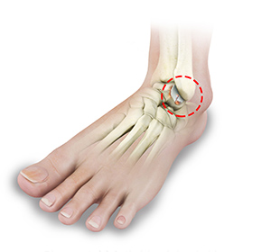 Foot and Ankle Arthritis