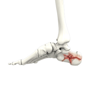 Foot Fractures