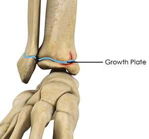 growth-plate-inury