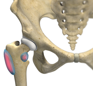 Hip Bursitis