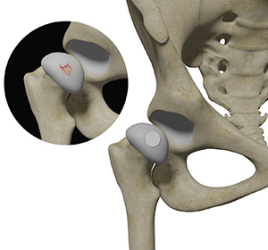 Hip Cartilage Restoration