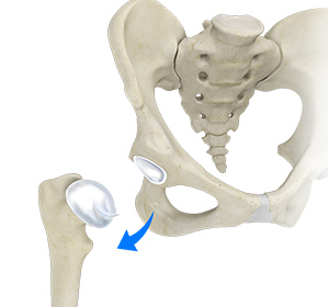 Hip Dislocation