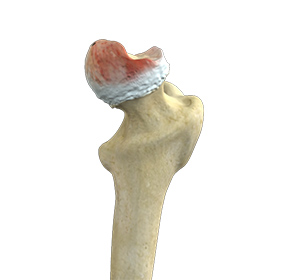 Hip Osteonecrosis