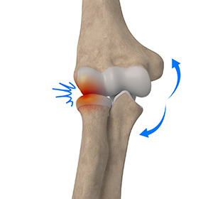 Lateral Impingement of the Elbow