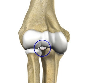 Loose Bodies in the Elbow