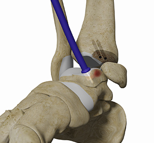 Cubital Tunnel Syndrome