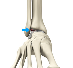 Cubital Tunnel Syndrome