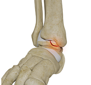 osteochondral-lesions-of-the-ankle
