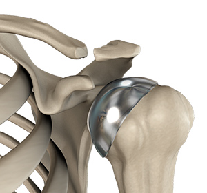 Partial Shoulder Replacement