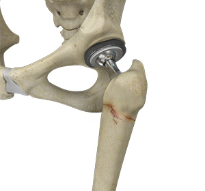 Periprosthetic Hip Fractures