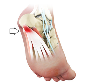 Plantar Fasciitis